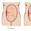 Особливості ведення вагітності та пологів при тазовому передлежанні плода