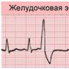 Як виявити на кардіограмі позачергові скорочення серця?